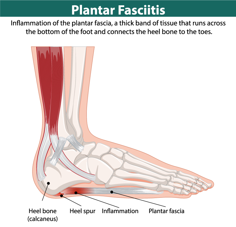 Plantar Fasciitis for Runners: Recovery Prevention
