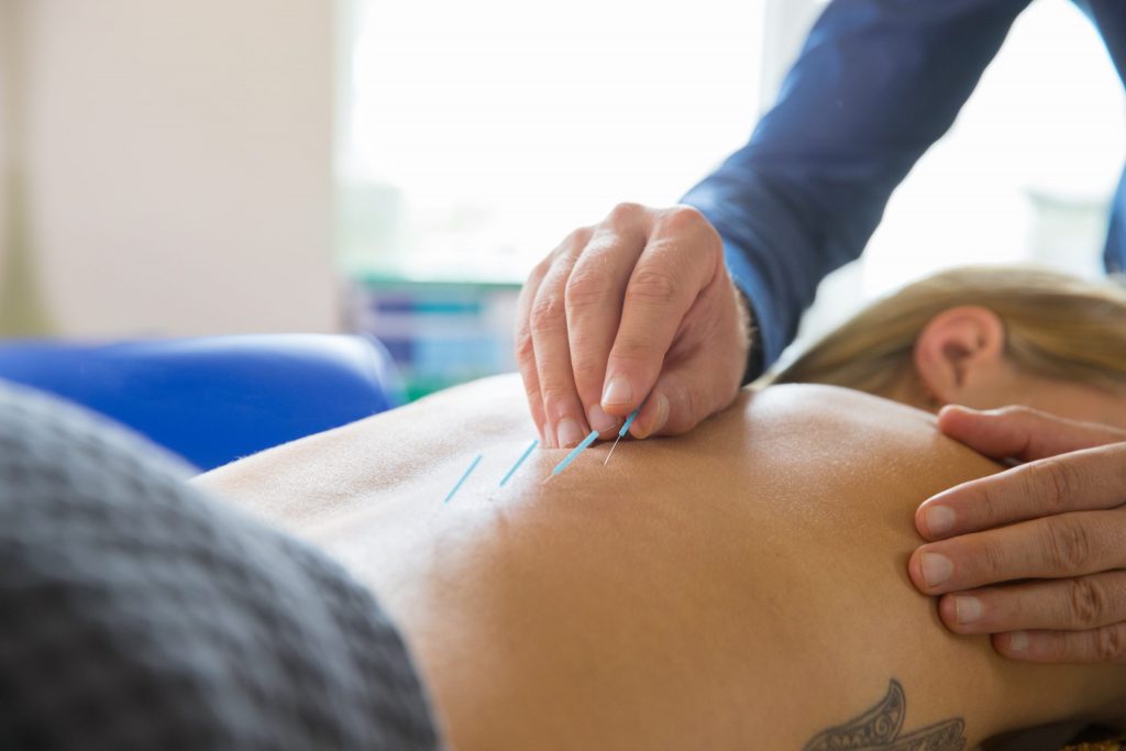 Dry Needling in Richmond hill